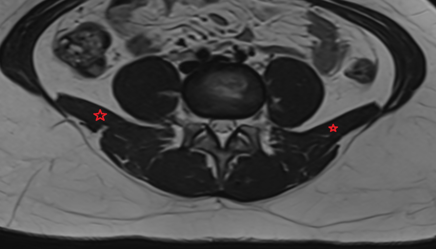 Quadratus lumborum muscle  MRI axial  image anatomy  image -img-00000-00000_00001