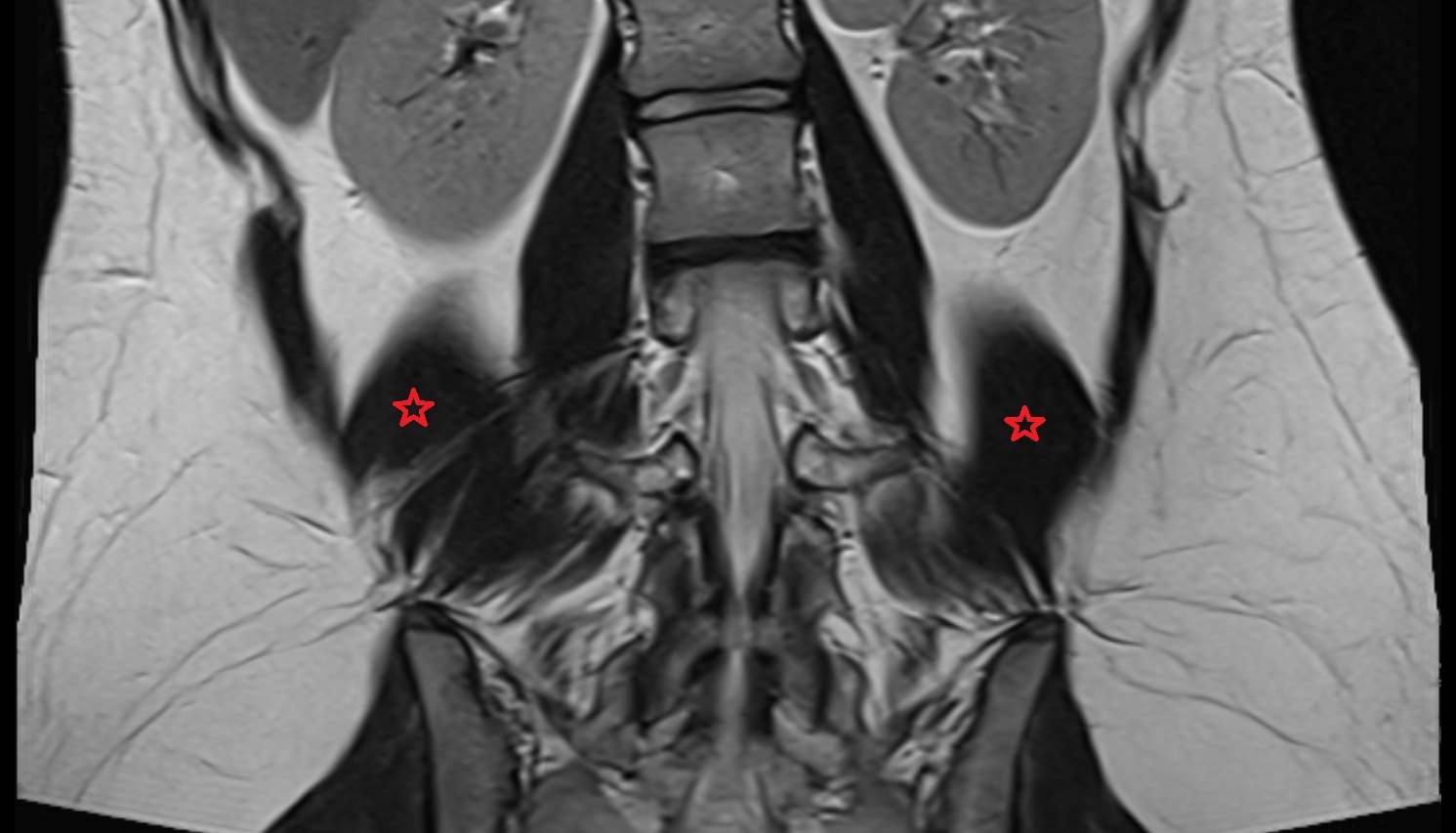 Quadratus lumborum muscle  MRI coronal  image anatomy  image -img-00000-00000