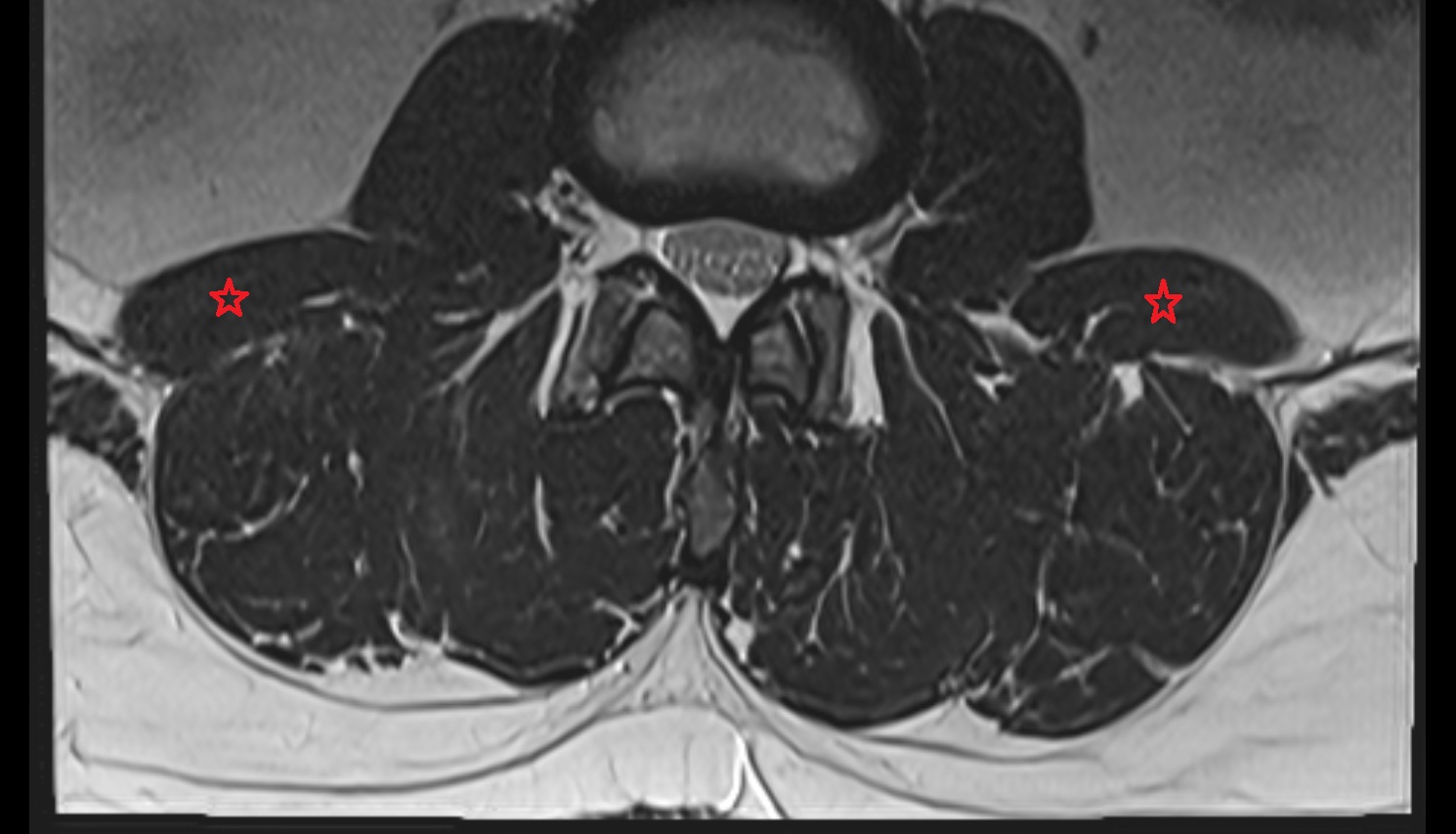 Quadratus lumborum muscle  mri  axial anatomy  image-img-00000-00000