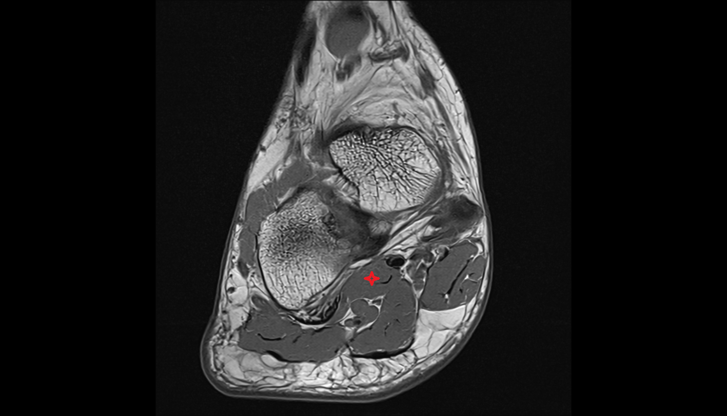 Quadratus plantae muscle axial cross sectional anatomy 3T MRI AI enhanced radiology image-img-00000-00000
