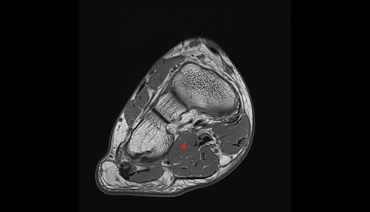 Quadratus plantae muscle axial cross sectional anatomy 3T MRI AI enhanced radiology image-img-00000-00000_00001