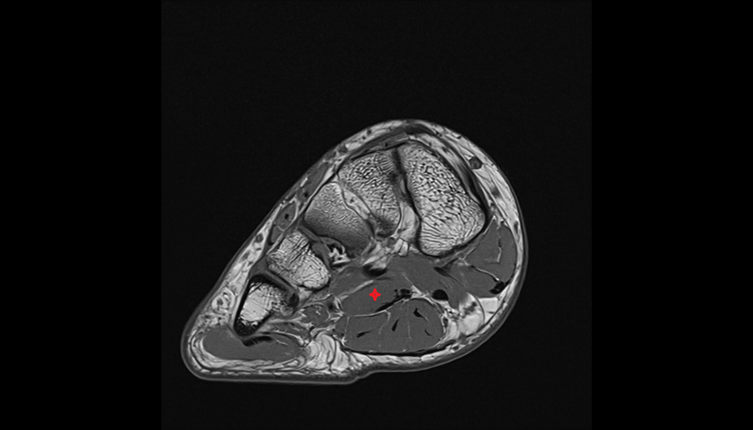 Quadratus plantae muscle axial cross sectional anatomy 3T MRI AI enhanced radiology image-img-00000-00000_00002