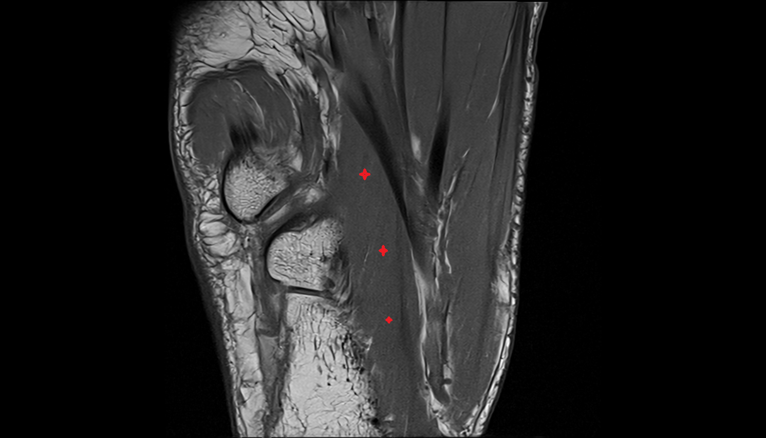 Quadratus plantae muscle coronal cross sectional anatomy 3T MRI AI enhanced radiology image-img-00000-00000