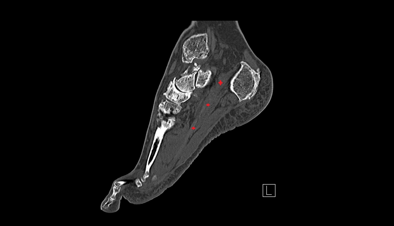 Quadratus plantae muscle ct sagittal