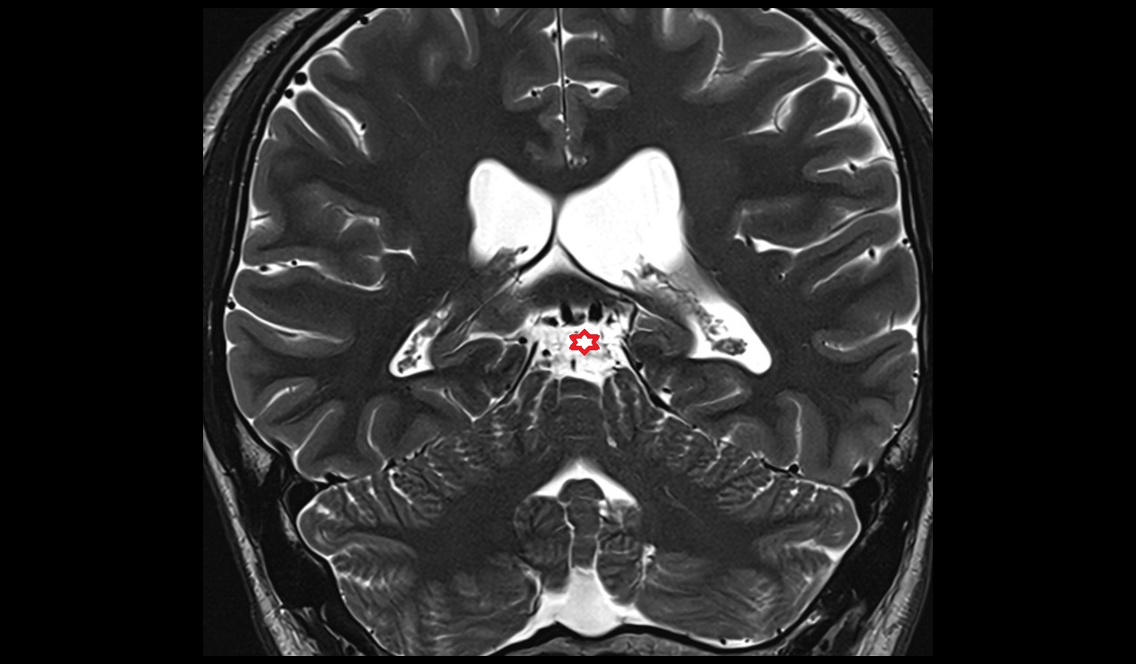 Quadrigeminal cistern; Cistern of great cerebral vein mri 3t coronal image