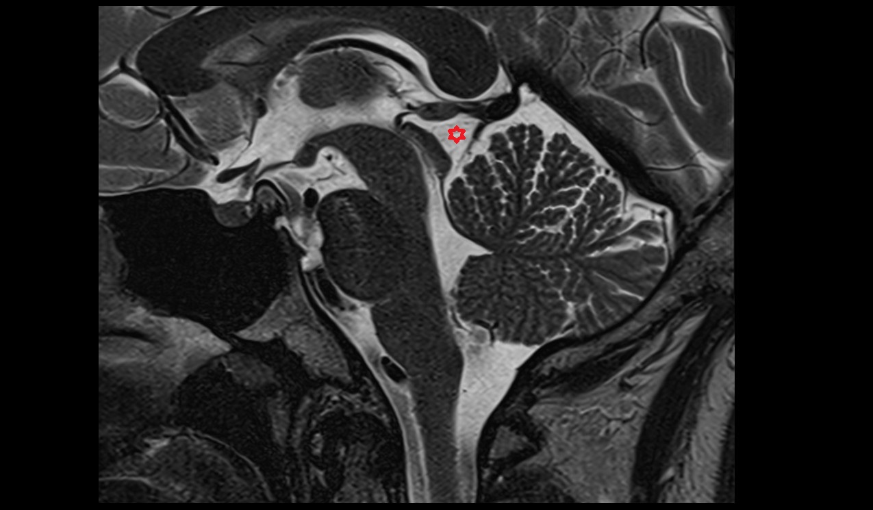 Quadrigeminal cistern; Cistern of great cerebral vein mri 3t sagittal image