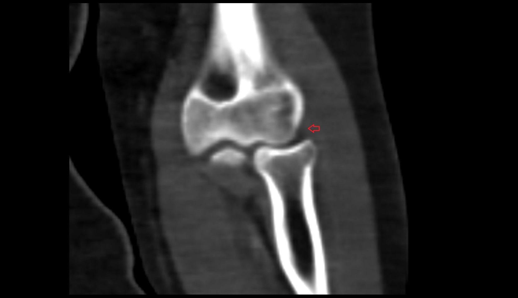 Radial Collateral Ligament ct image
