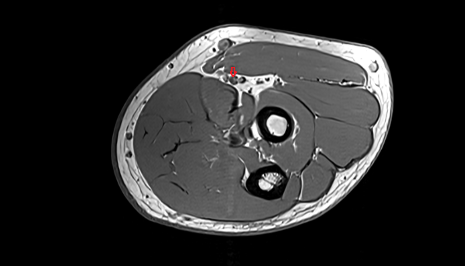 Radial artery axial cross sectional anatomy 3T MRI AI enhanced radiology image -img-00000-00000