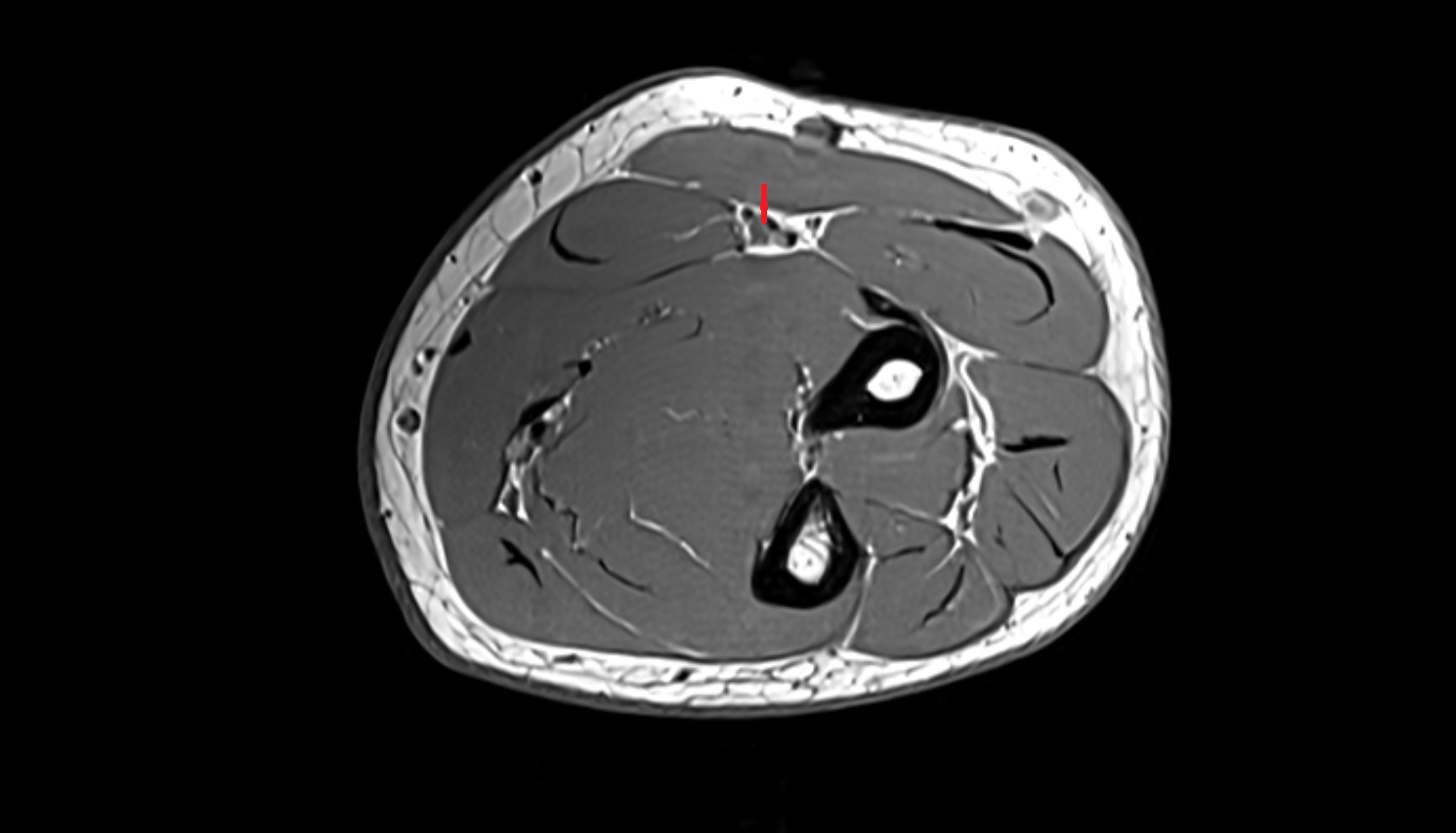 Radial artery axial cross sectional anatomy 3T MRI AI enhanced radiology image -img-00000-00000_00001