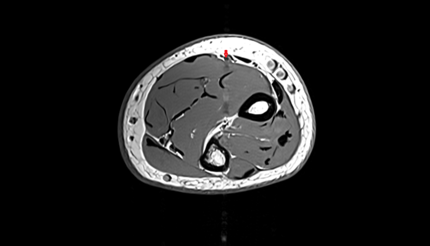 Radial artery axial cross sectional anatomy 3T MRI AI enhanced radiology image -img-00000-00000_00002