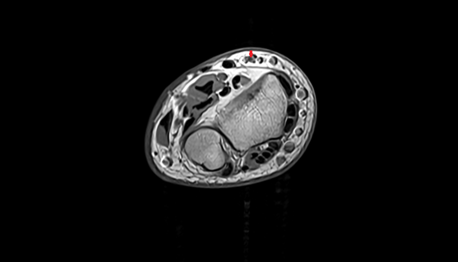 Radial artery axial cross sectional anatomy 3T MRI AI enhanced radiology image -img-00000-00000_00003