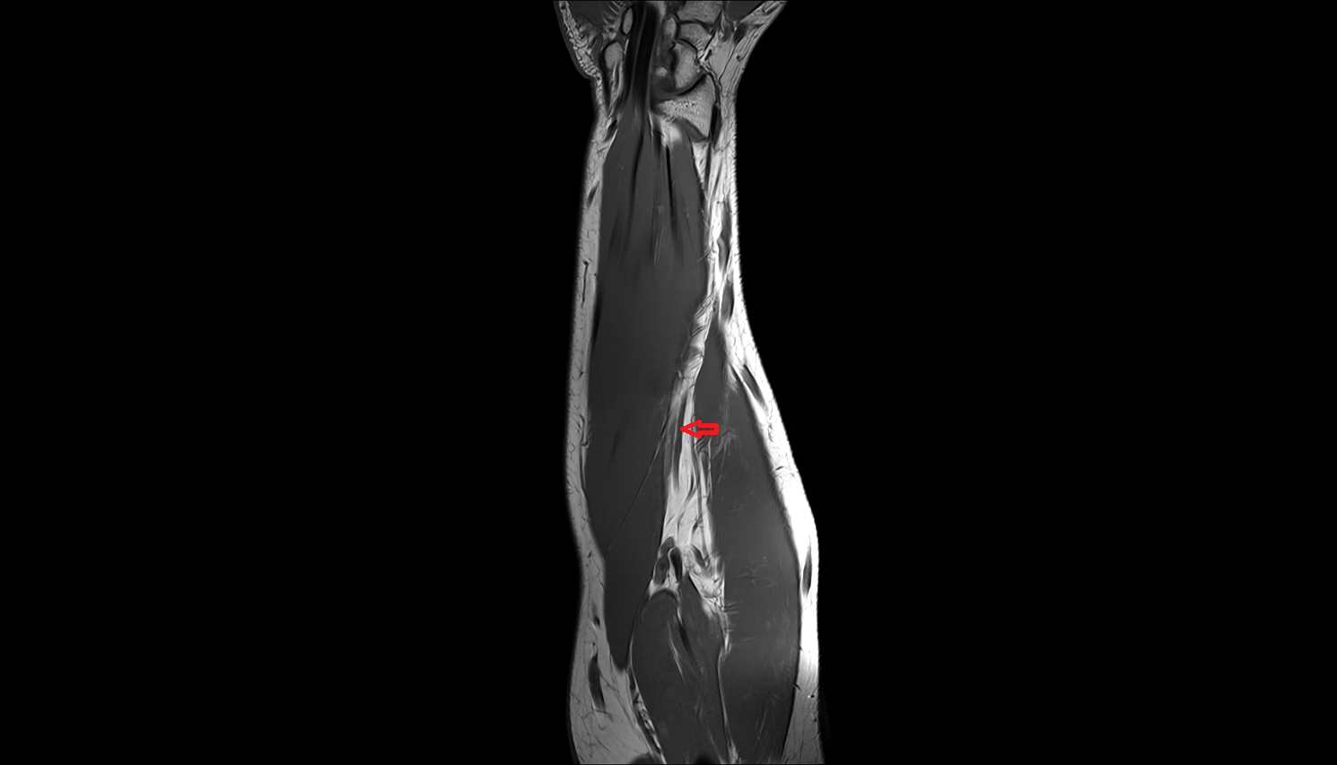 Radial artery coronal cross sectional anatomy 3T MRI AI enhanced radiology image -img-00000-00000