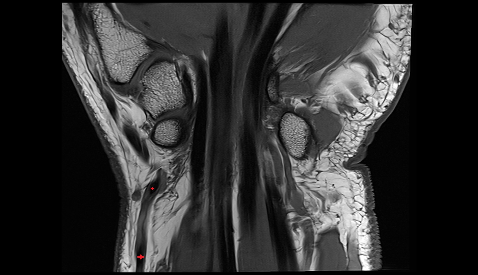 Radial artery coronal wrist image mri