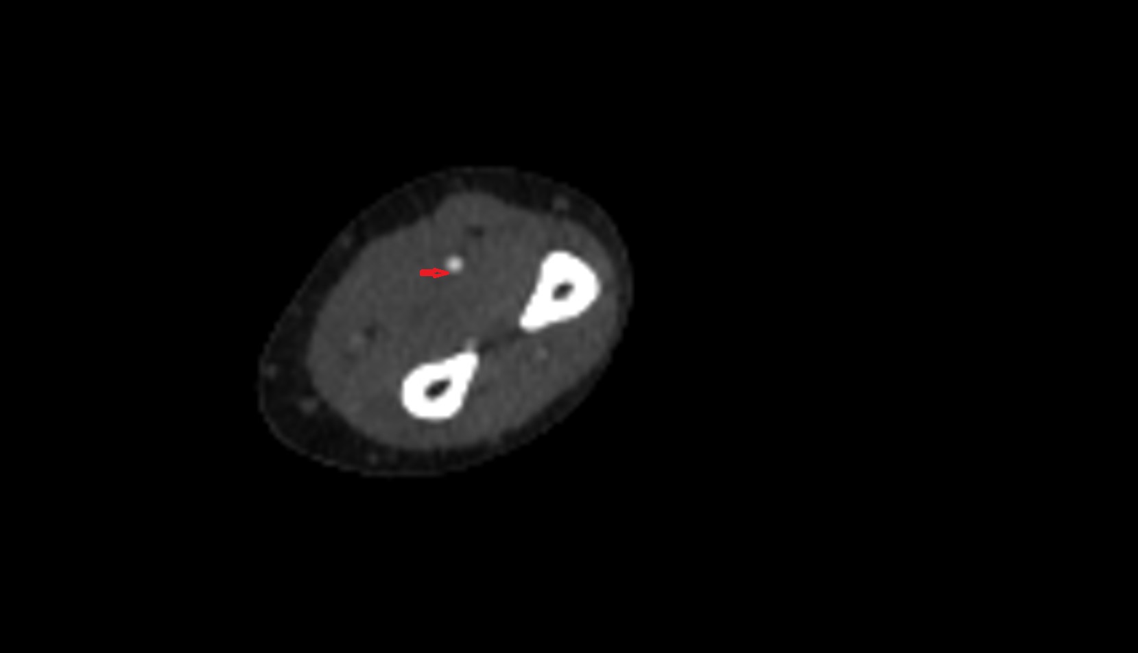 Radial artery ct axial image