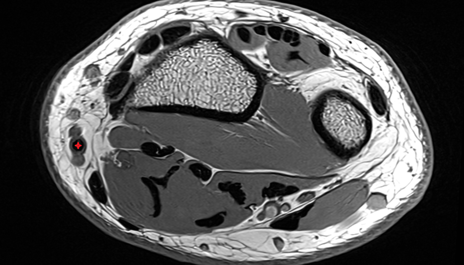 Radial artery wrist axial cross sectional anatomy 3T MRI AI enhanced radiology image-img-00000-00000