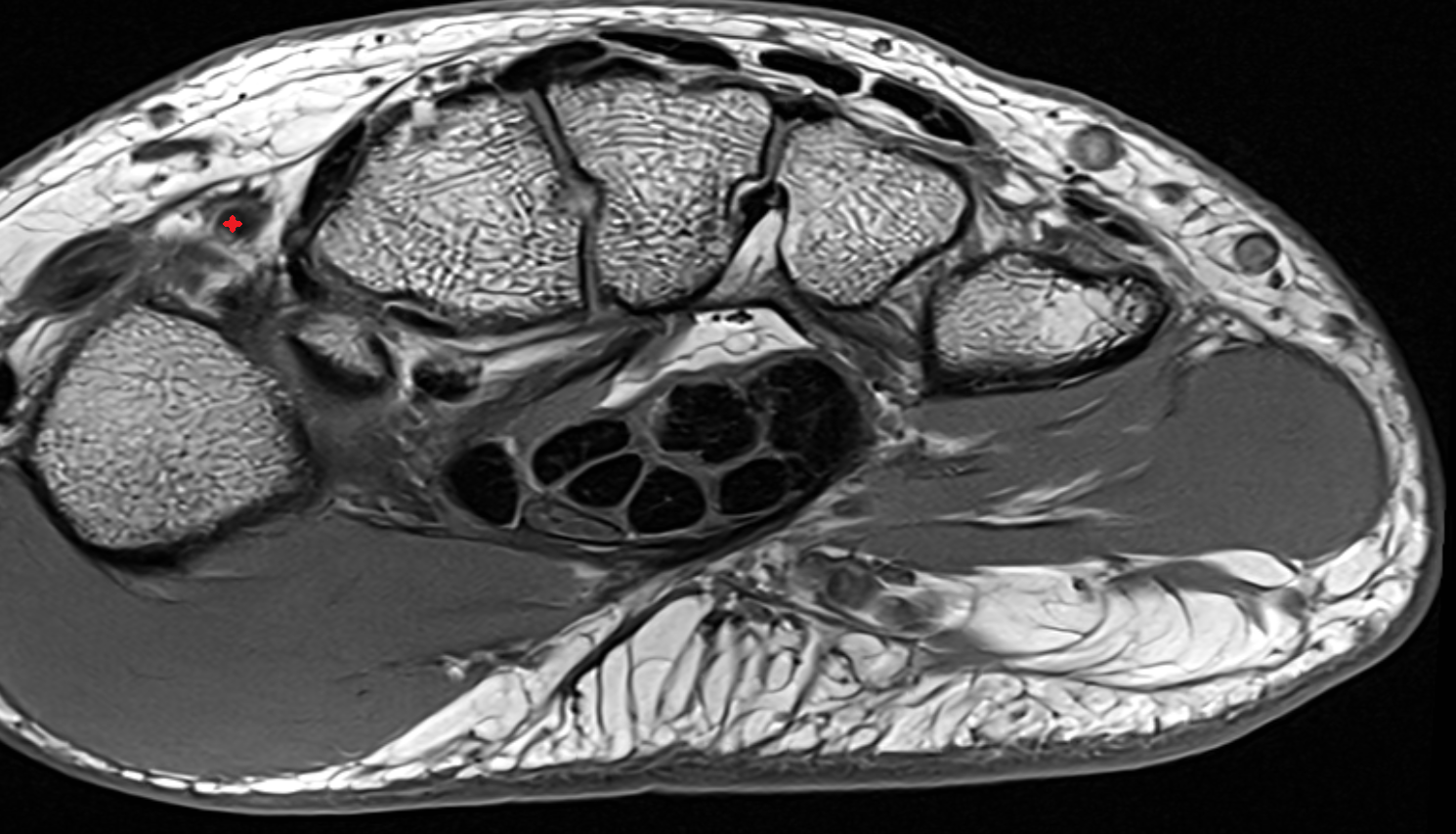 Radial artery wrist axial cross sectional anatomy 3T MRI AI enhanced radiology image-img-00000-00000_00001