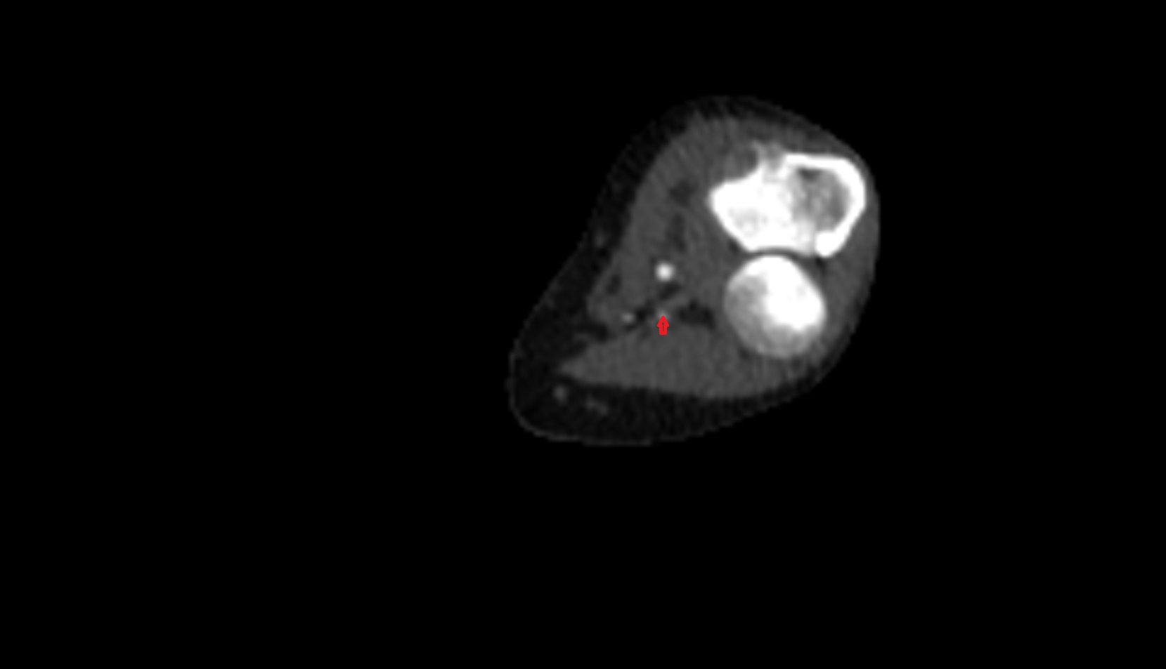 Radial collateral artery CT IMAGE
