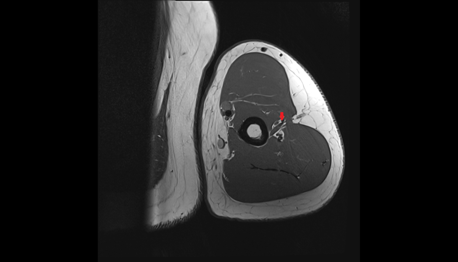 Radial collateral artery axial cross sectional anatomy 3T MRI AI enhanced radiology image -img-00000-00000