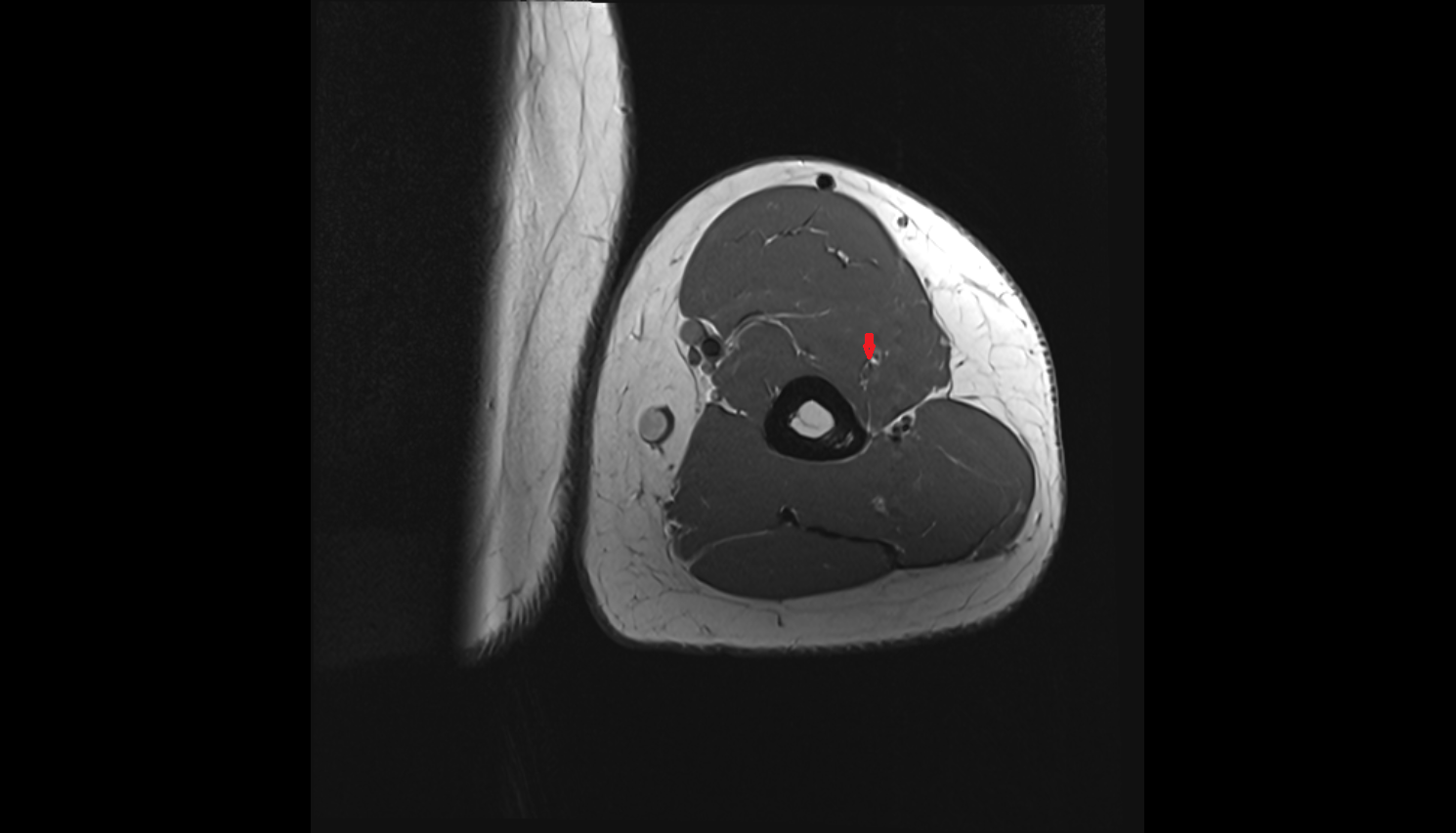 Radial collateral artery axial cross sectional anatomy 3T MRI AI enhanced radiology image -img-00000-00000_00001