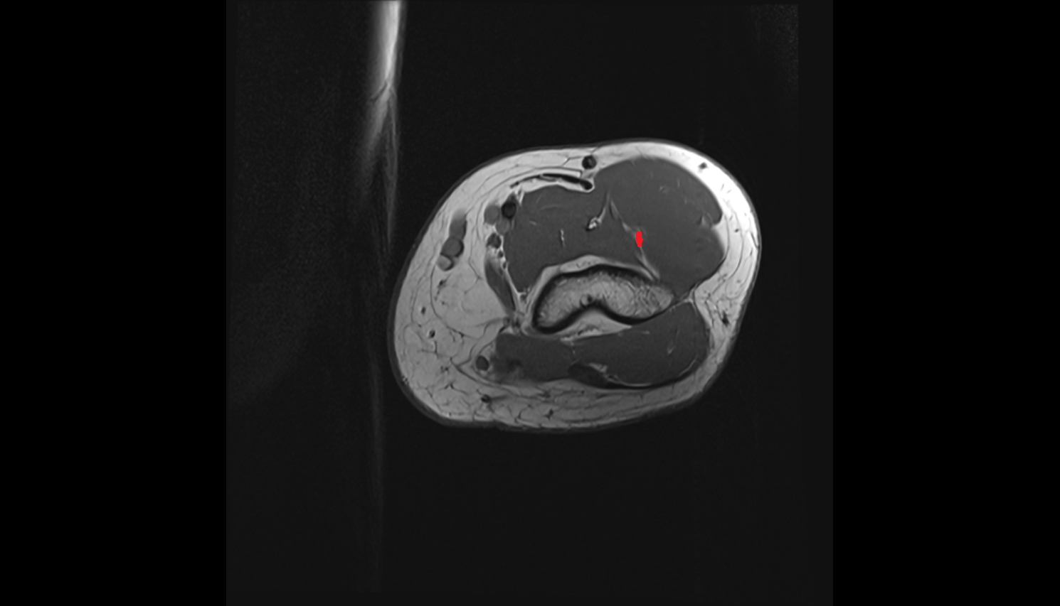 Radial collateral artery axial cross sectional anatomy 3T MRI AI enhanced radiology image -img-00000-00000_00002