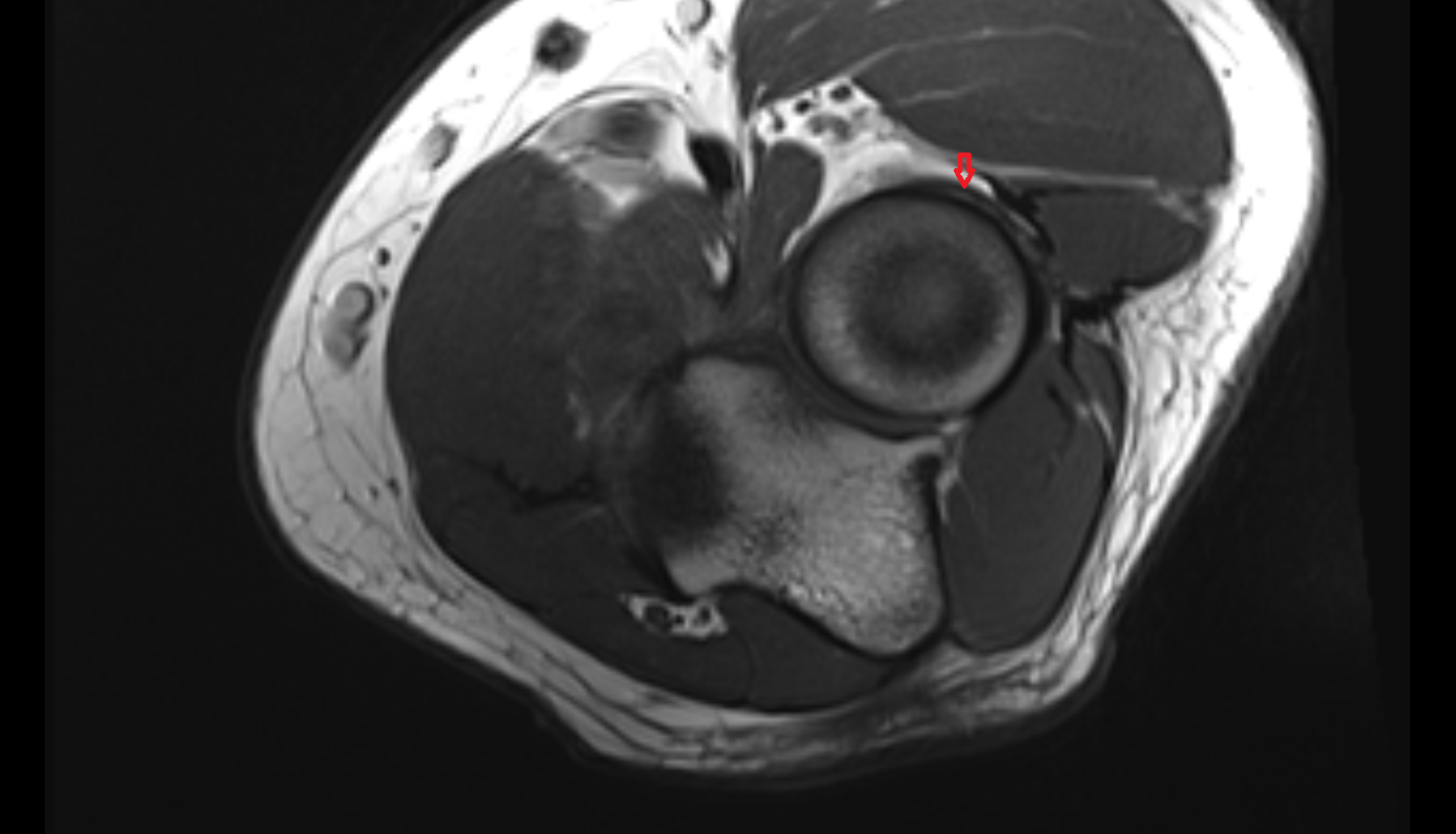 Radial collateral ligament axial cross sectional anatomy 3T MRI AI enhanced radiology image -img-00000-00000