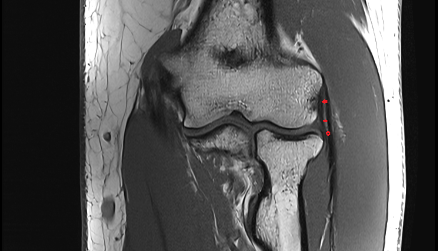 Radial collateral ligament coronal cross sectional anatomy 3T MRI AI enhanced radiology image -img-00000-00000