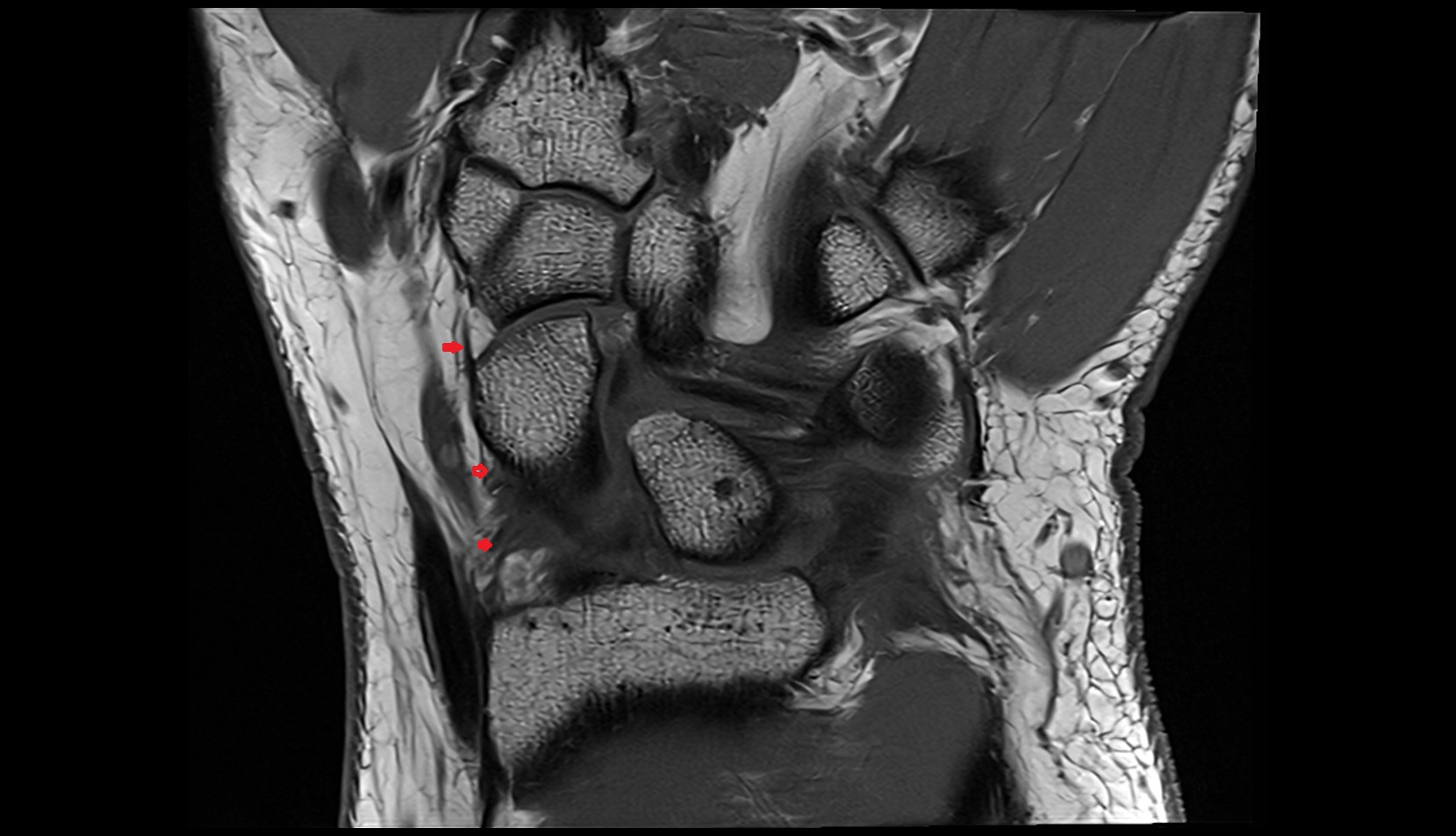 Radial collateral ligament of wrist coronal