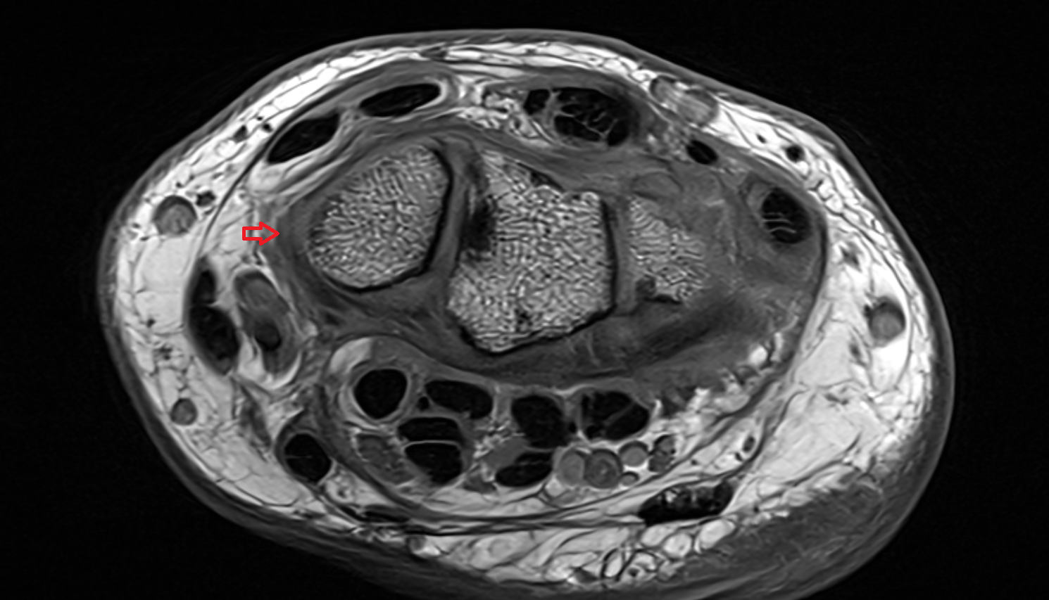 Radial collateral ligament of wrist  mri coronal image  axial cross sectional anatomy 3T MRI AI enhanced radiology image-img-00000-00000