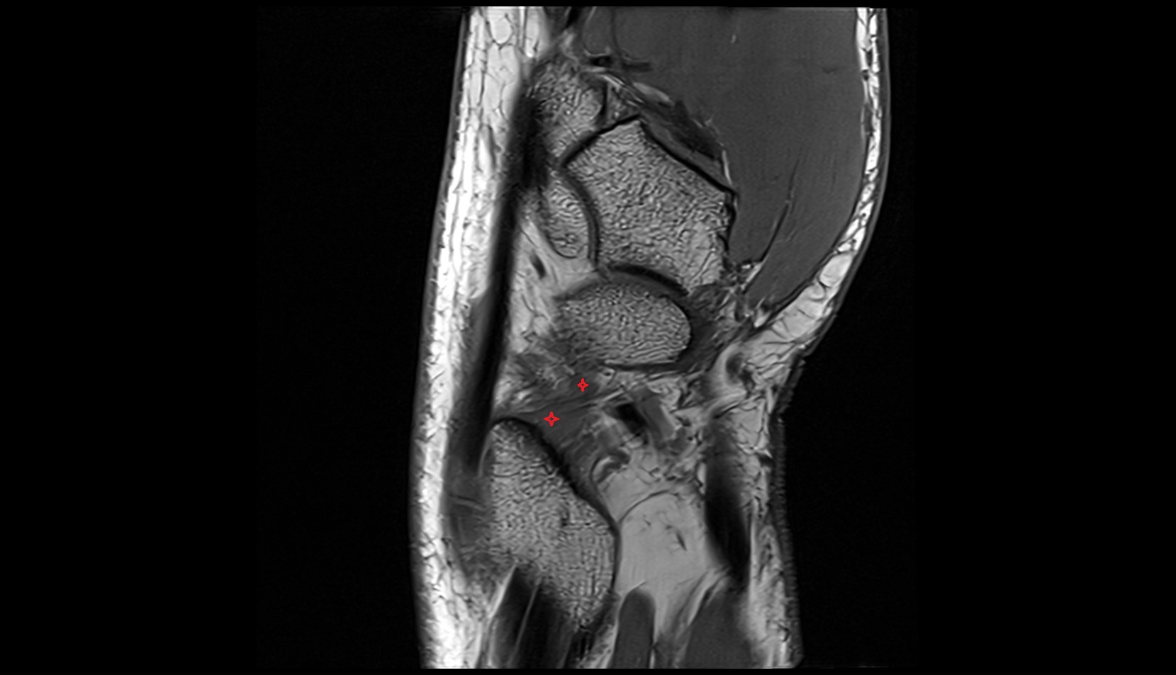 Radial collateral ligament of wrist sagittal mri image