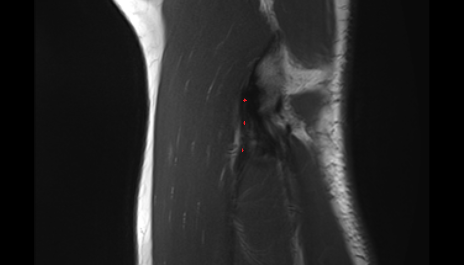 Radial collateral ligament sag cross sectional anatomy 3T MRI AI enhanced radiology image -img-00000-00000