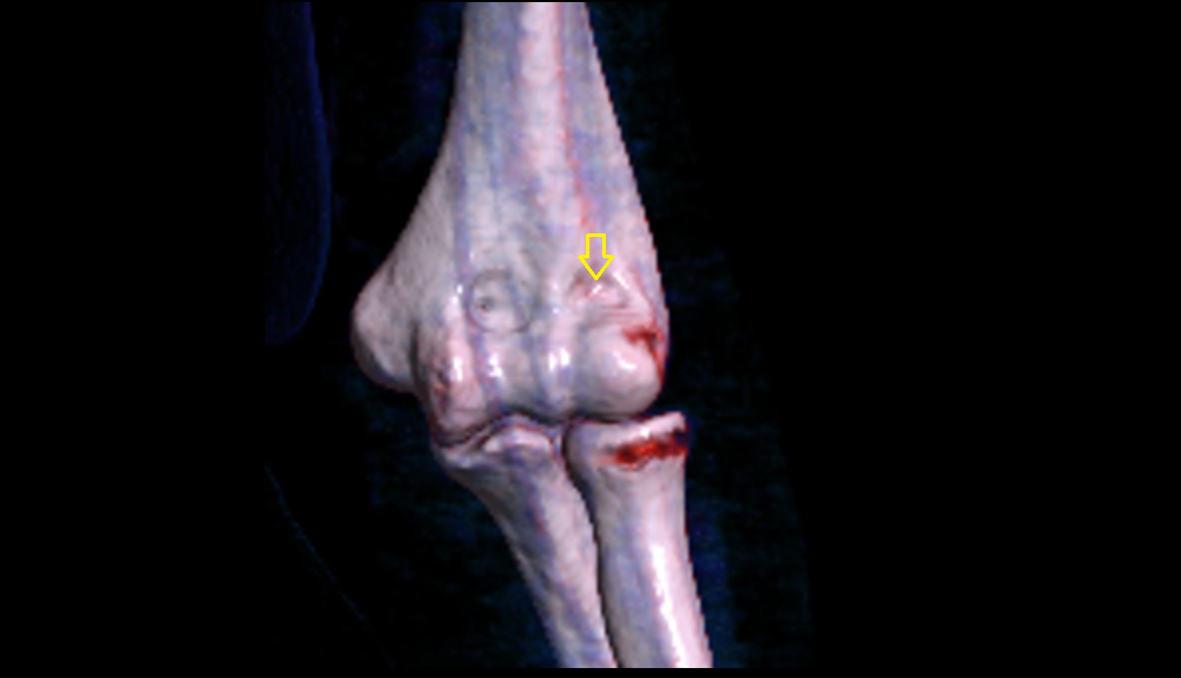 Radial fossa 3d image