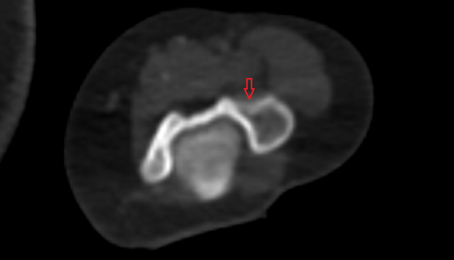 Radial fossa  ct  anatomy labelled image-img-00000-00000