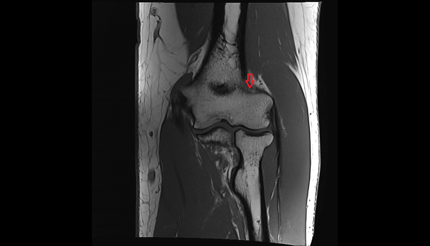 Radial fossa mri  anatomy labelled image-img-00000-00000