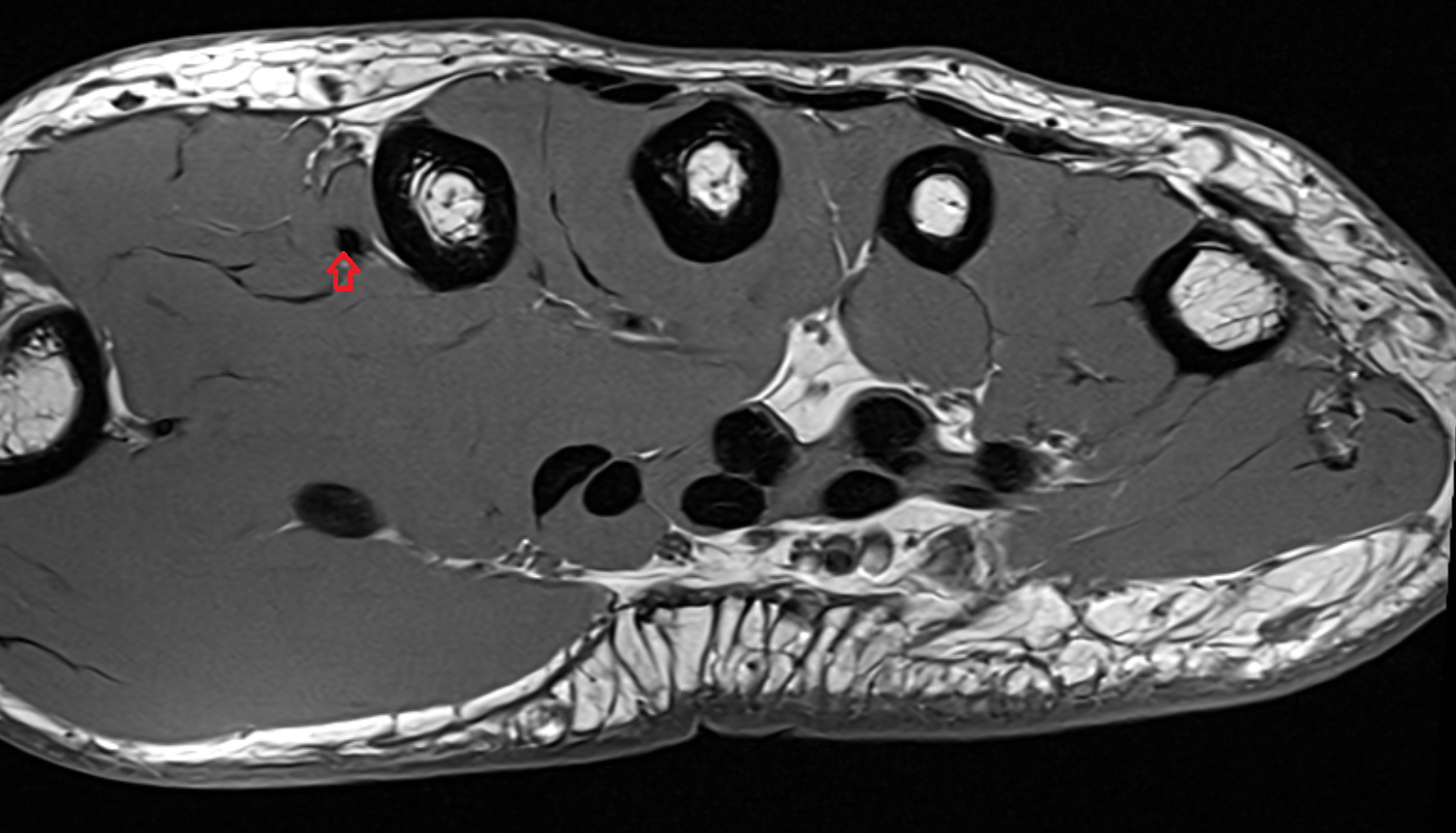 Radialis indicis artery  axial cross sectional anatomy 3T MRI AI enhanced radiology image-img-00000-00000