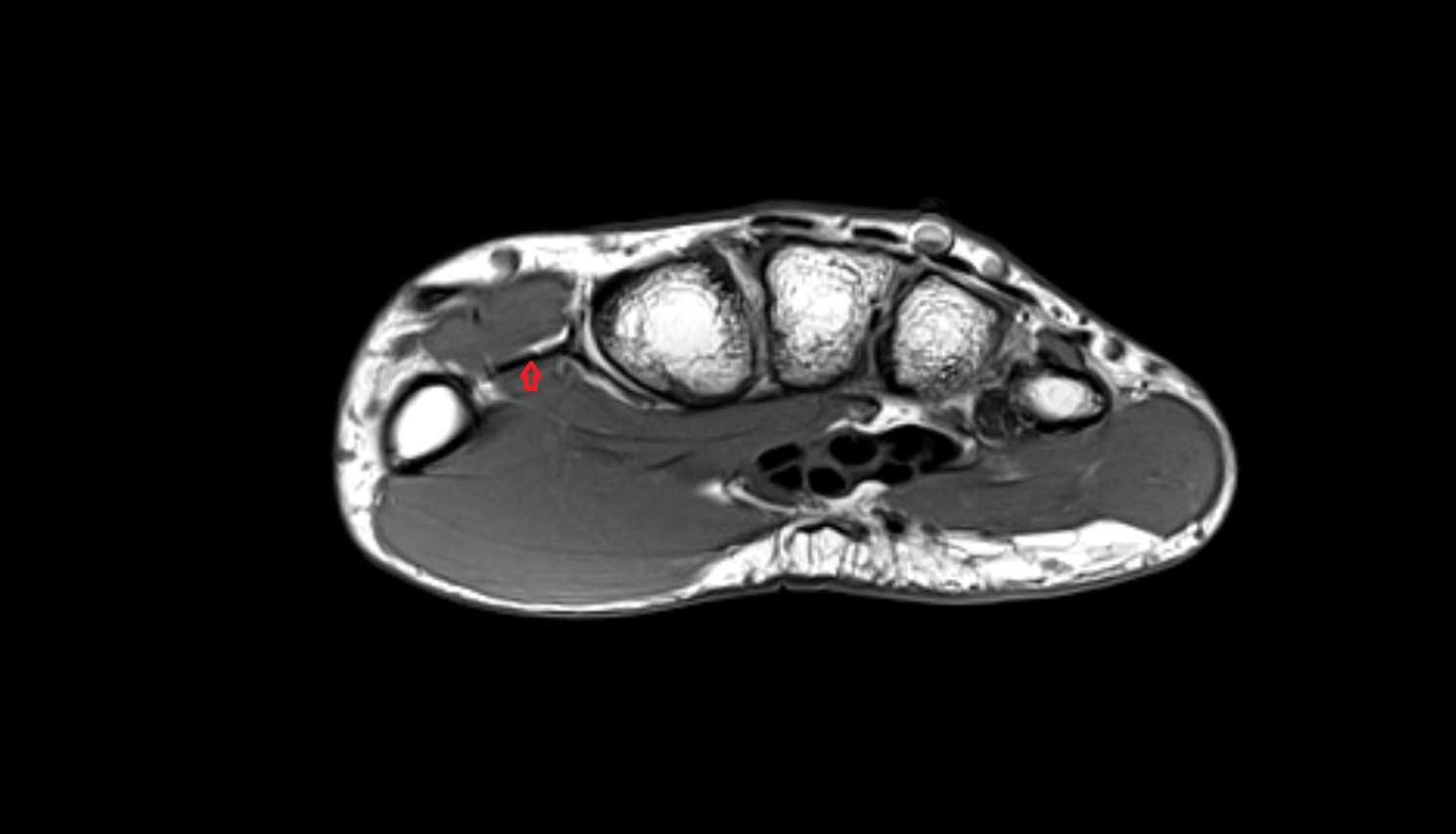 Radialis indicis artery  axial cross sectional anatomy 3T MRI AI enhanced radiology image-img-00000-00000_00001