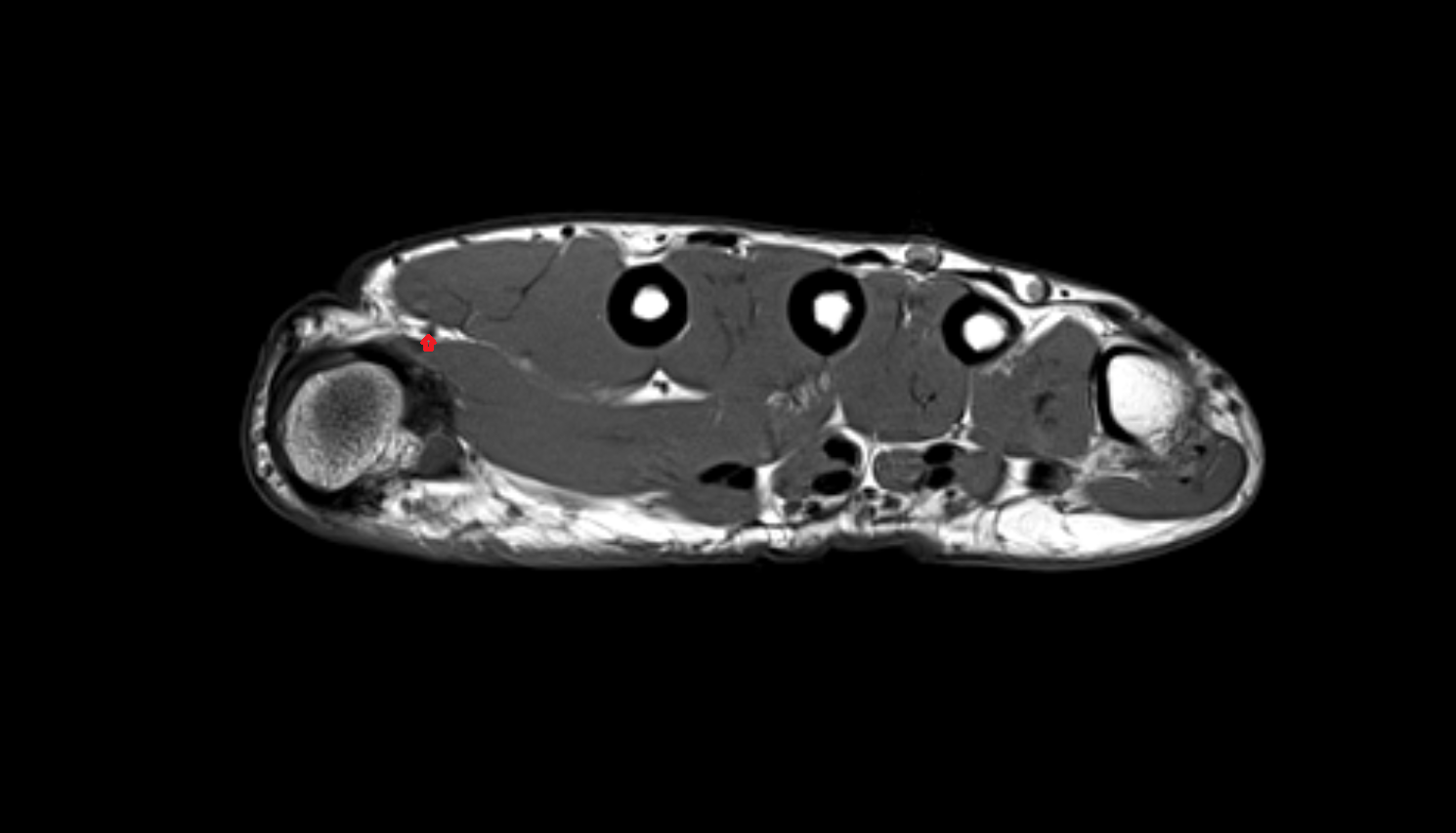 Radialis indicis artery  axial cross sectional anatomy 3T MRI AI enhanced radiology image-img-00000-00000_00002