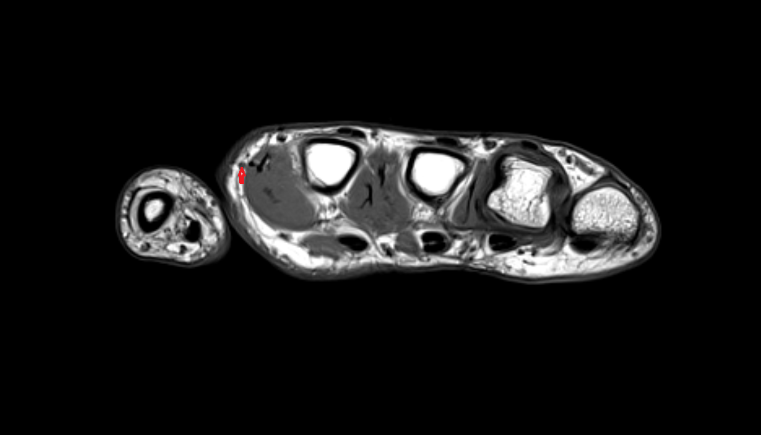Radialis indicis artery  axial cross sectional anatomy 3T MRI AI enhanced radiology image-img-00000-00000_00003