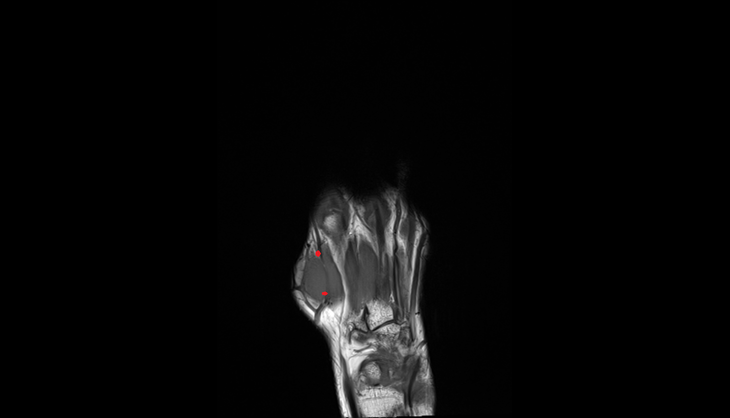 Radialis indicis artery  coronal cross sectional anatomy 3T MRI AI enhanced radiology image-img-00000-00000_00004