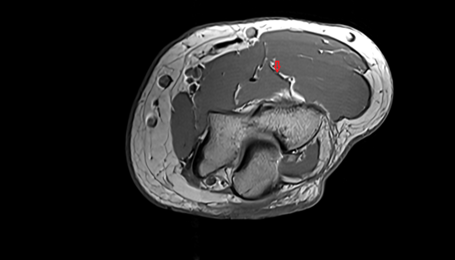 Radial nerve axial cross sectional anatomy 3T MRI AI enhanced radiology image-img-00000-00000