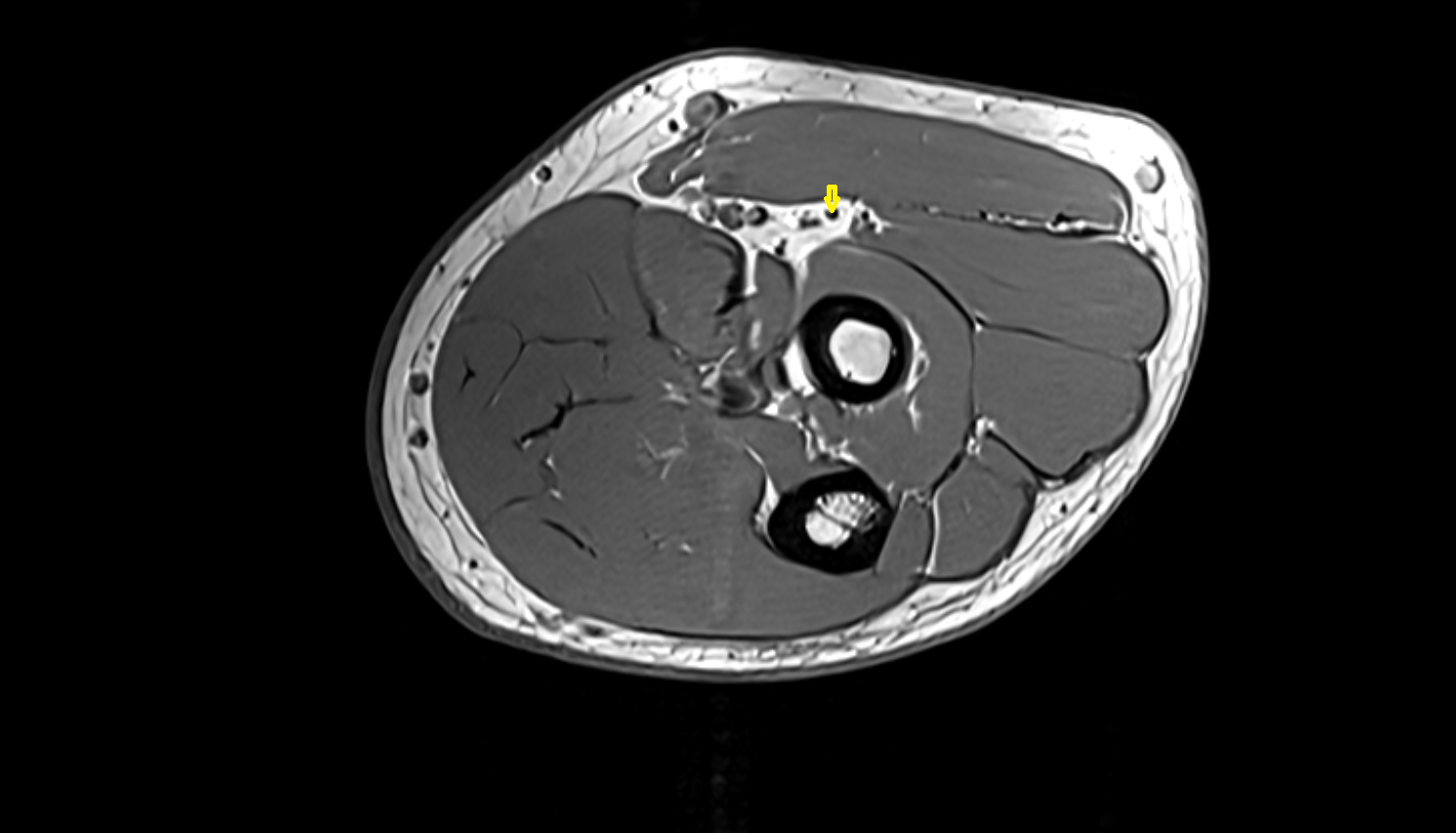 Radial nerve axial cross sectional anatomy 3T MRI AI enhanced radiology image-img-00000-00000_00001
