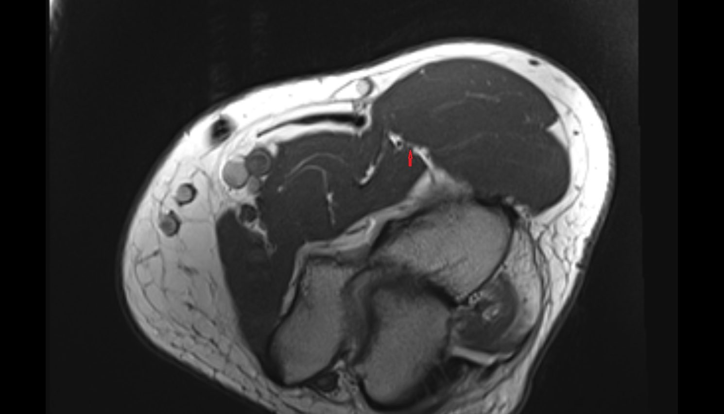 Radial nerve (deep branch)  axial cross sectional anatomy 3T MRI AI enhanced radiology image -img-00000-00000