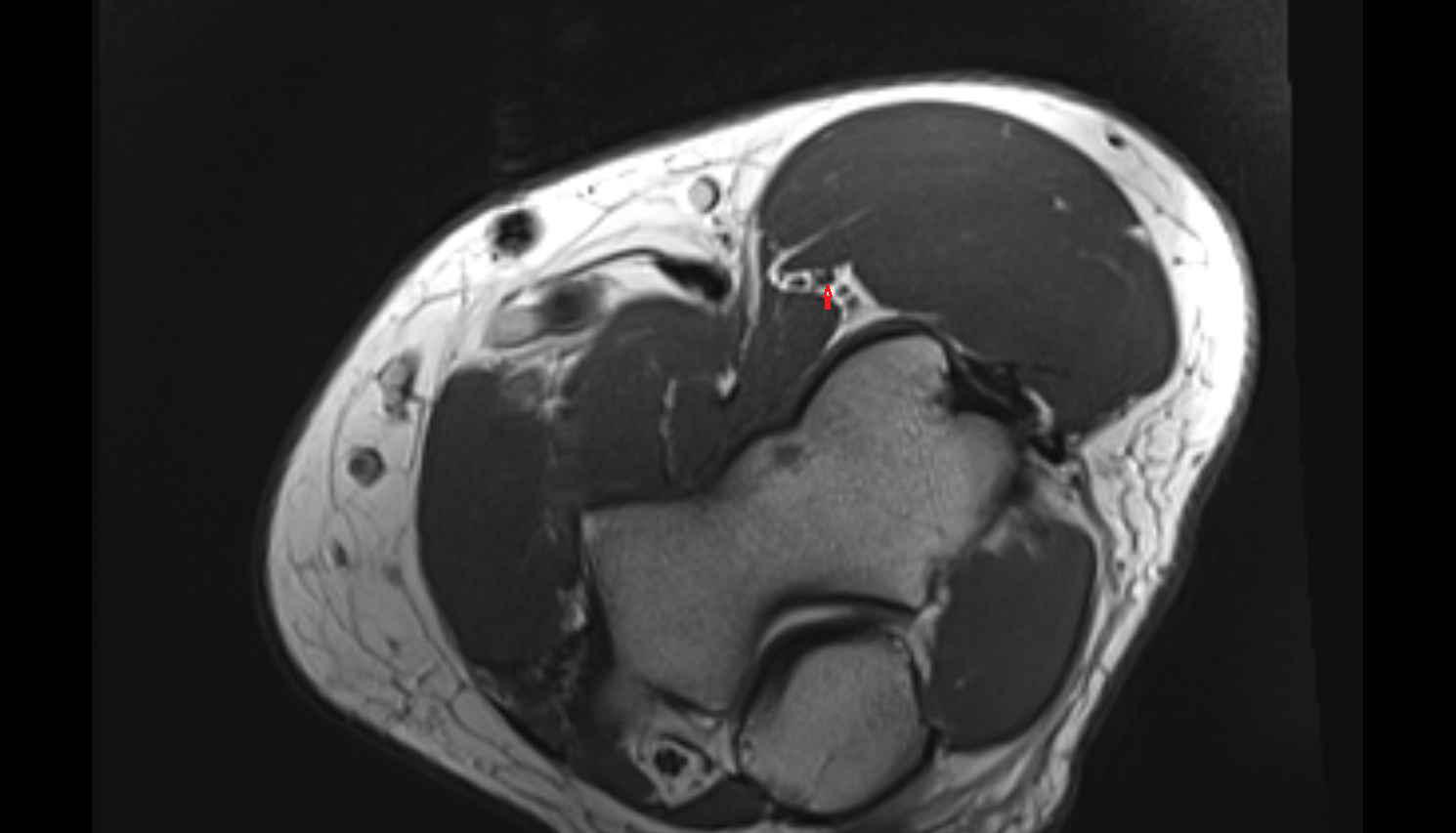 Radial nerve (deep branch)  axial cross sectional anatomy 3T MRI AI enhanced radiology image -img-00000-00000_00001