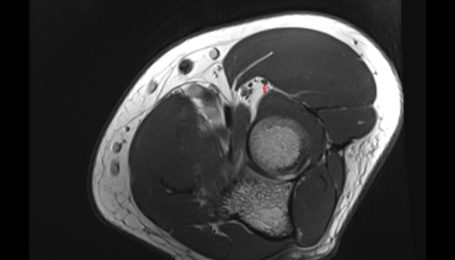 Radial nerve (deep branch)  axial cross sectional anatomy 3T MRI AI enhanced radiology image -img-00000-00000_00002