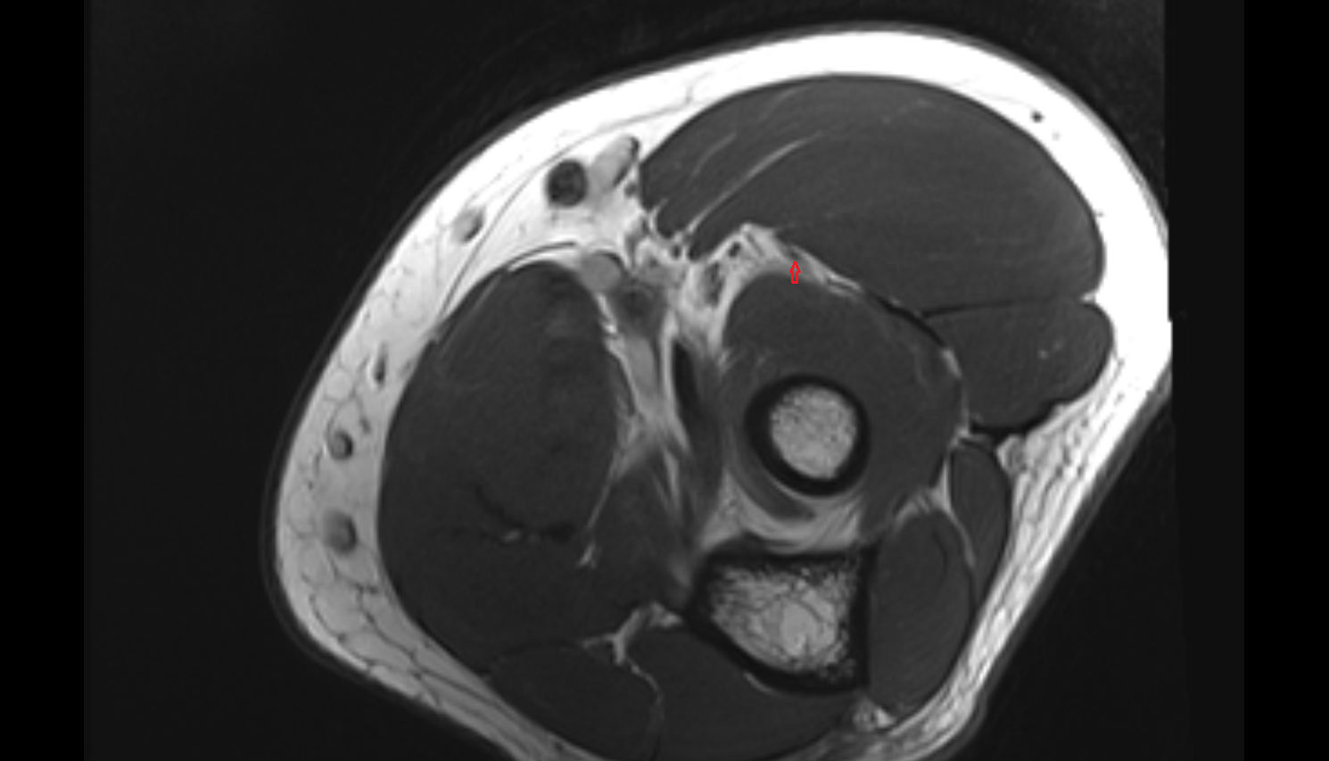 Radial nerve (deep branch)  axial cross sectional anatomy 3T MRI AI enhanced radiology image -img-00000-00000_00003
