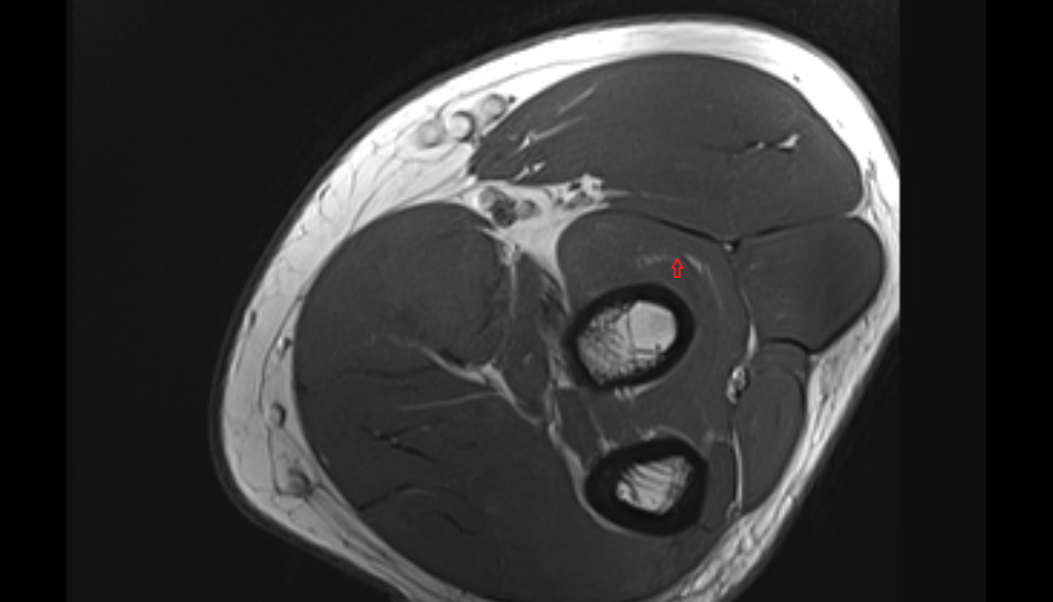 Radial nerve (deep branch)  axial cross sectional anatomy 3T MRI AI enhanced radiology image -img-00000-00000_00004