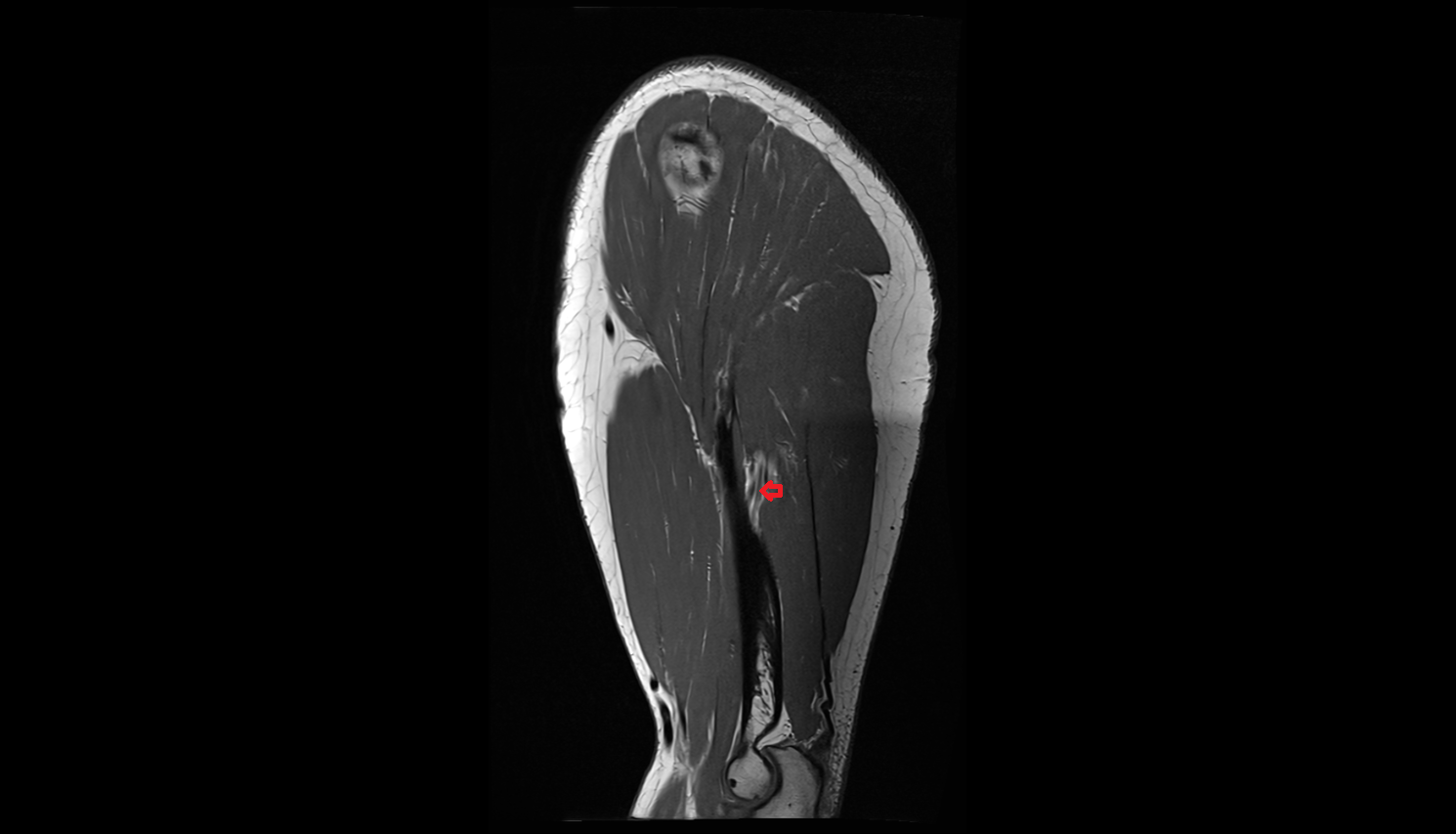 Radial nerve sag cross sectional anatomy 3T MRI AI enhanced radiology image-img-00000-00000