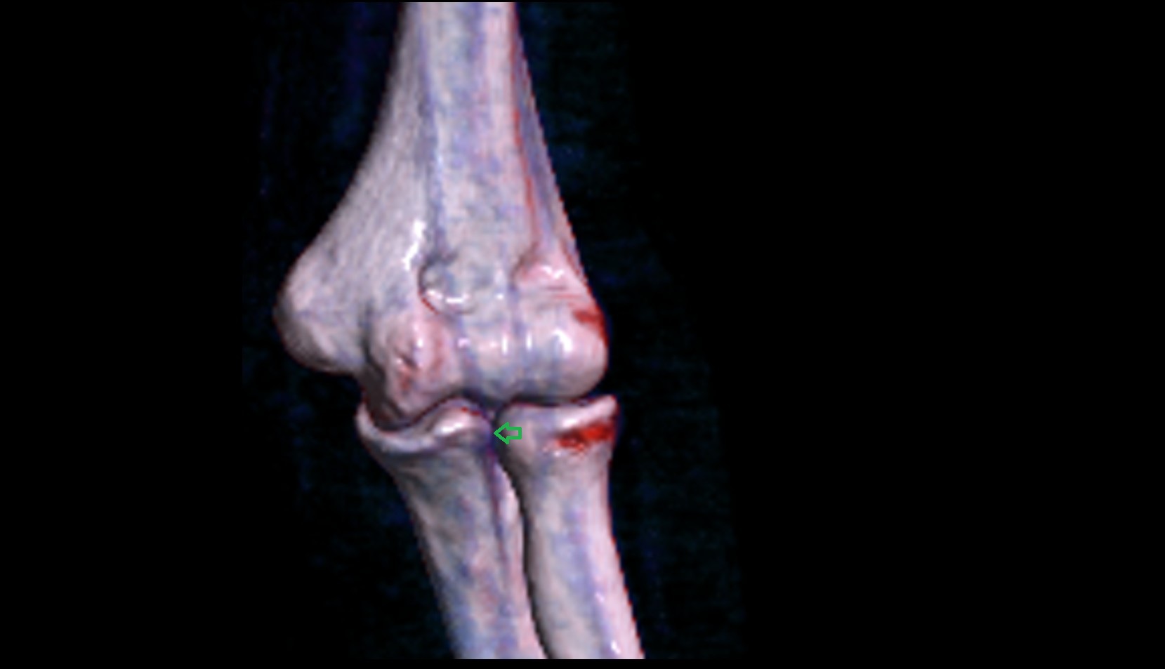 Radial notch of ulna 3d image