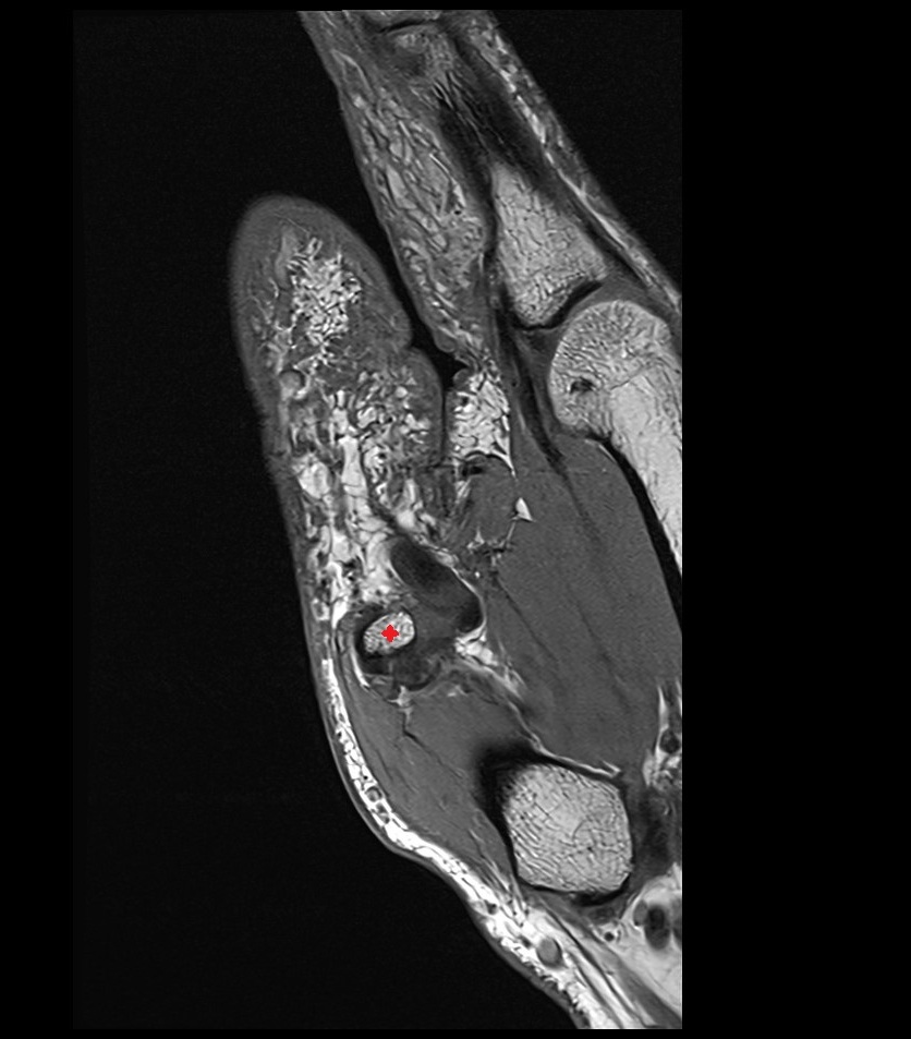 Radial sesamoid bone of thumb mri coronal