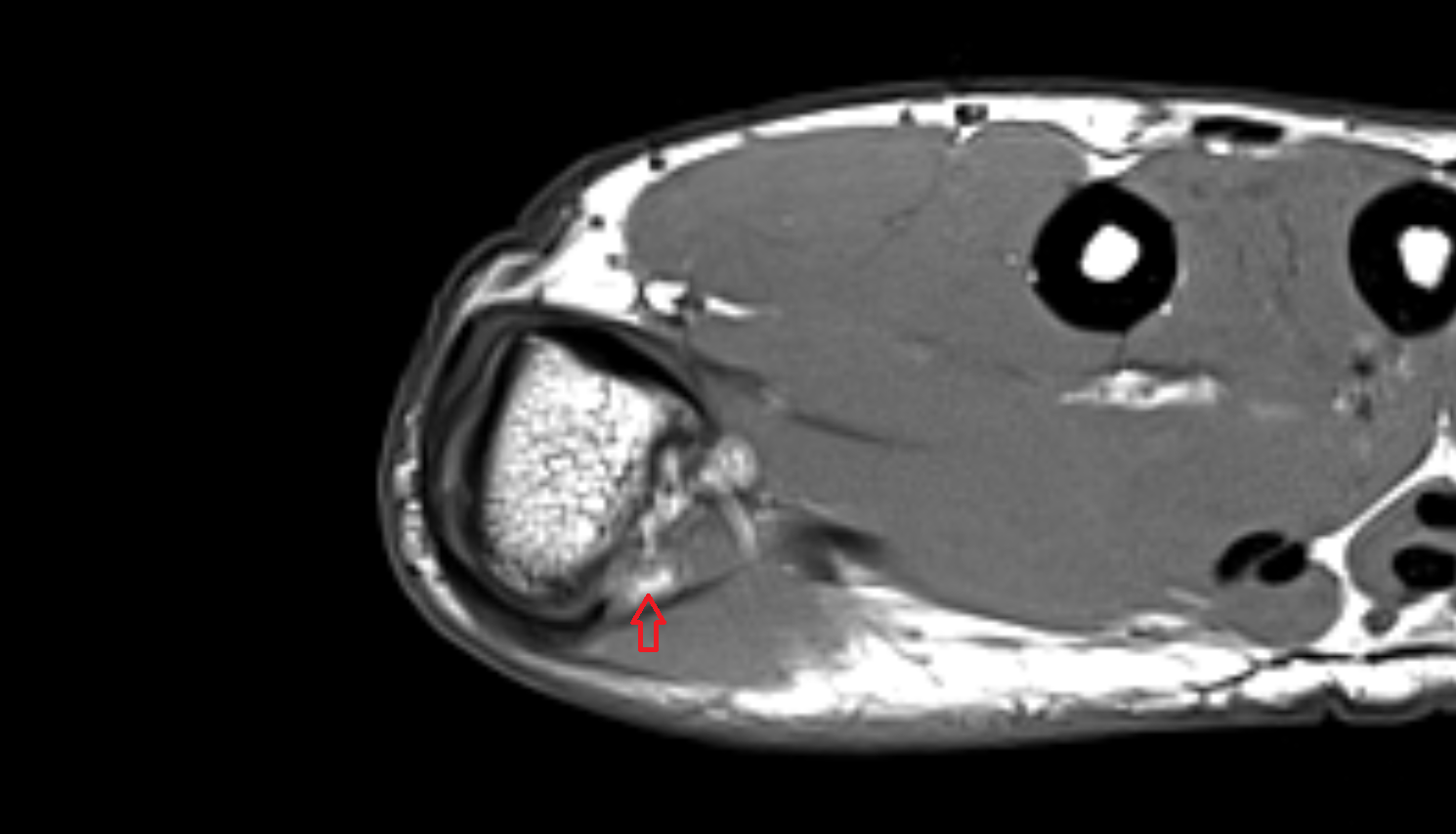 Radial sesamoid bone of thumb mri  anatomy labelled image-img-00000-00000