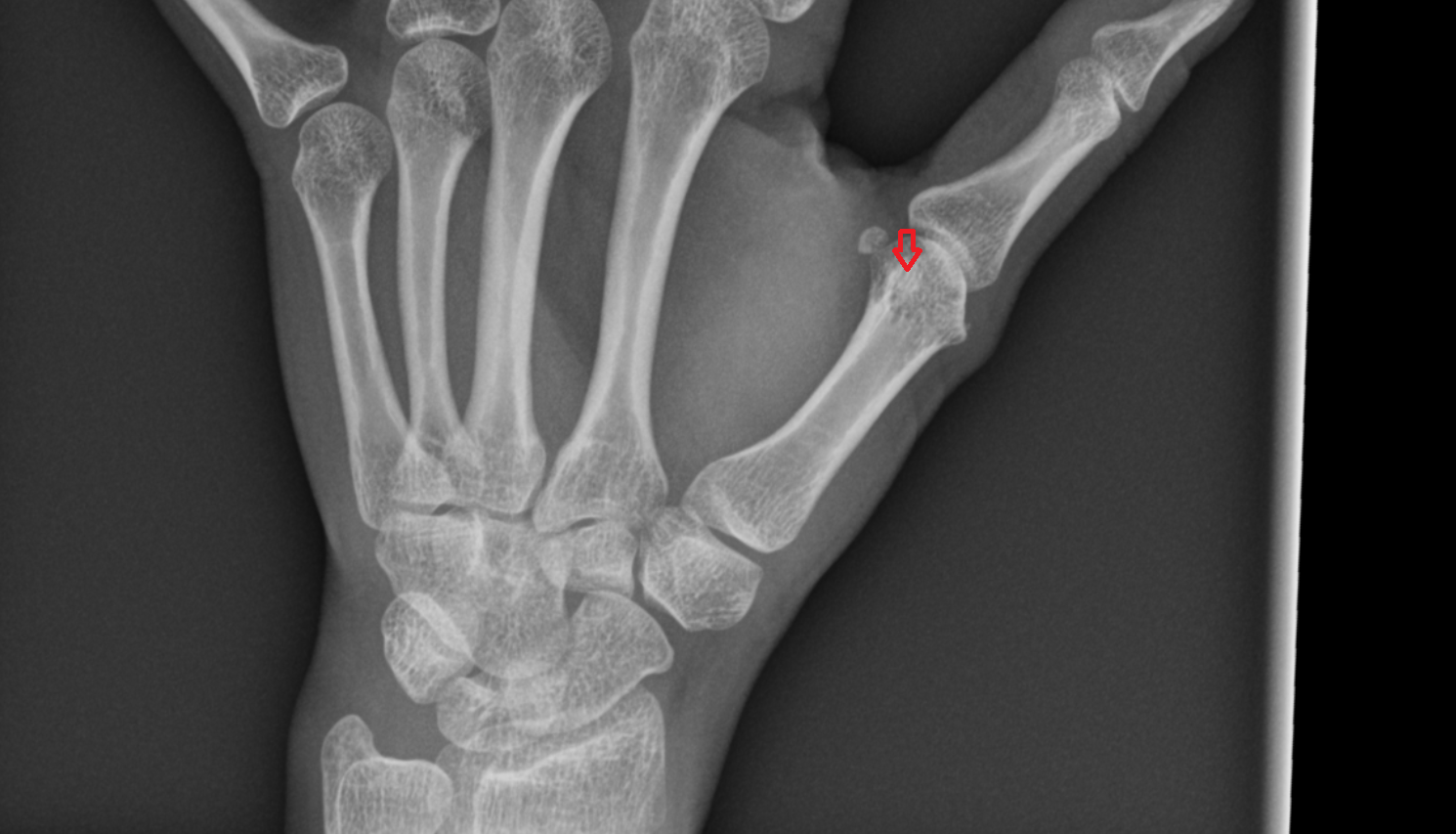 Radial sesamoid bone of thumb x ray  anatomy labelled image-img-00000-00000